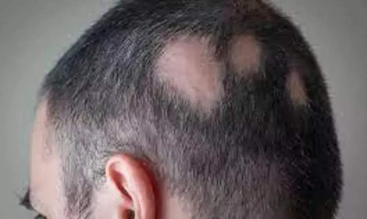 Patients with Psoriasis at greater risk of Developing Alopecia Areata