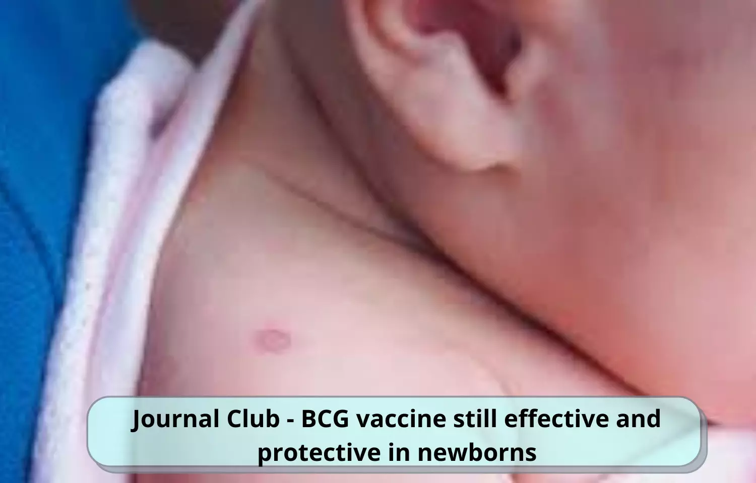 Journal Club - BCG vaccine still effective and protective in newborns