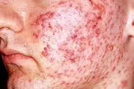 Intense Pulsed Light and Minocycline Combo better than Monotherapy in Acne Vulgaris