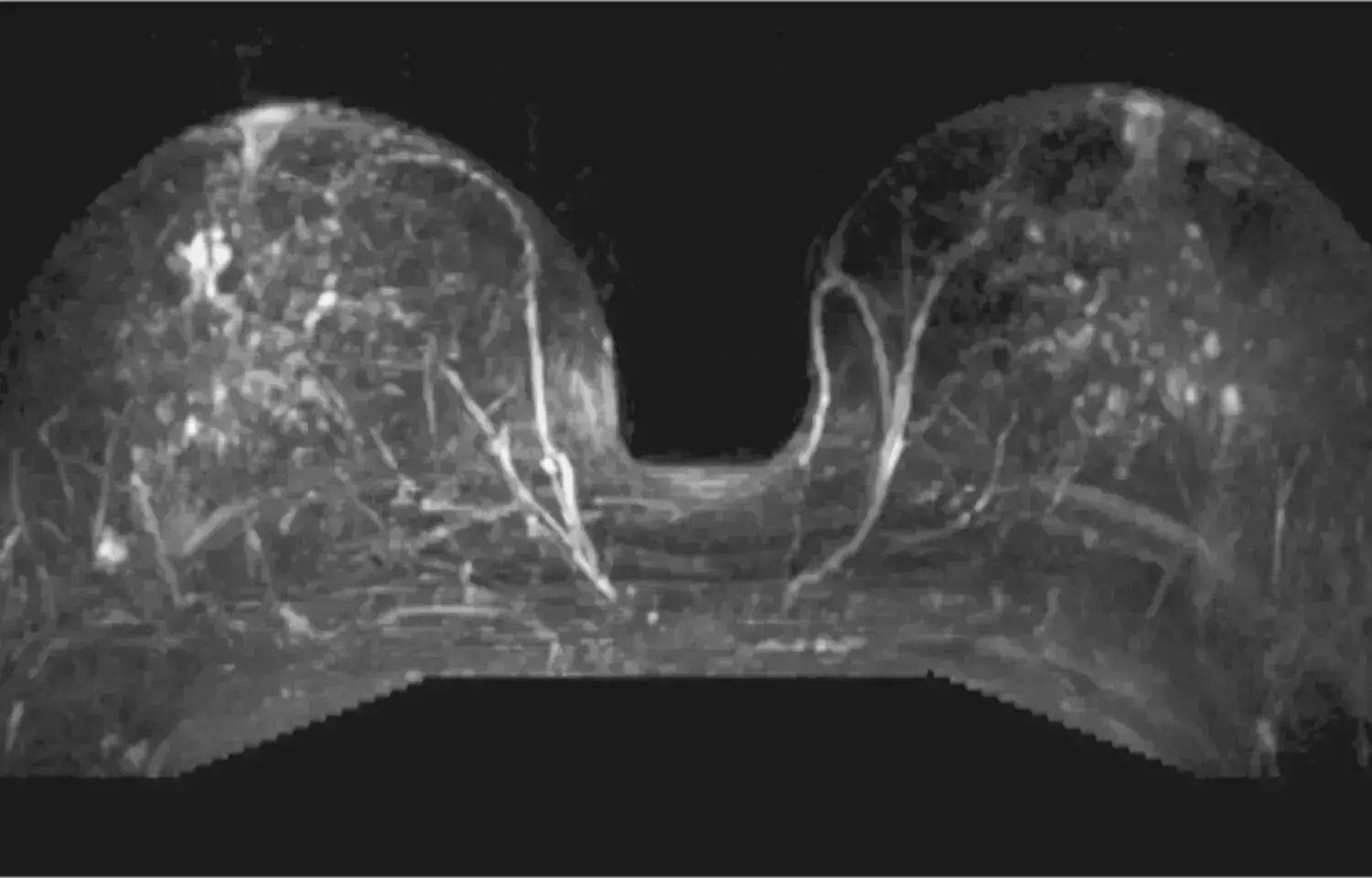 Breast MRI can guide surgery preference for ductal carcinoma in situ: JAMA