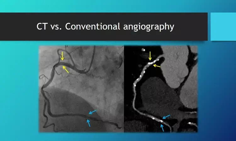 CT angiography yields similar event rates as invasive coronary angiography for stable angina patients, DISCHARGE  trial.