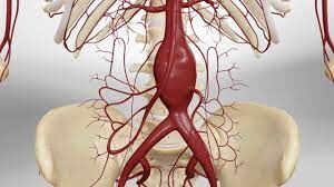 Endovascular aneurysm repair tied with long-term rupture and ...