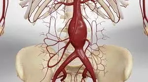 Endovascular aneurysm repair tied with long-term rupture and intervention: JAMA