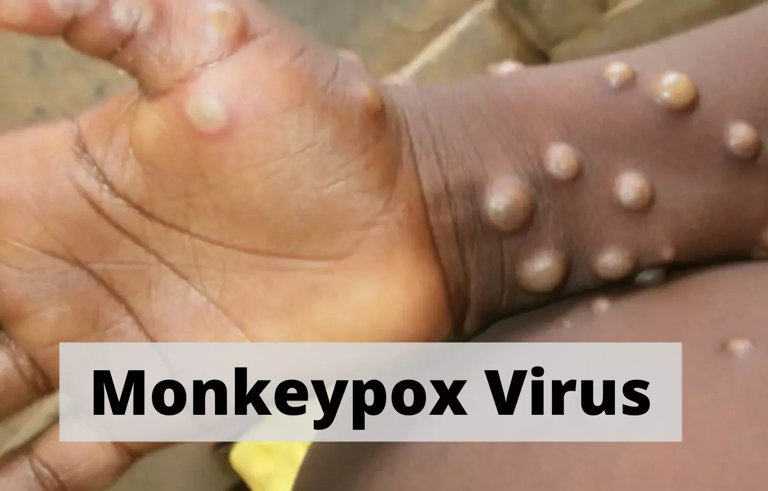 Monkeypox Virus: Health Ministry issues Guidelines for treatment
