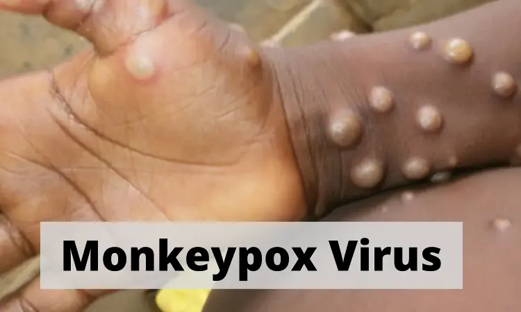 Reserve 10 beds in COVID Hospitals for suspected Monkeypox patients: CM Yogi Adityanath