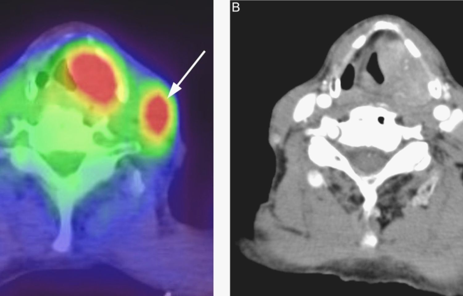 FDG-PET/CT can predict distant metastasis and survival in ...