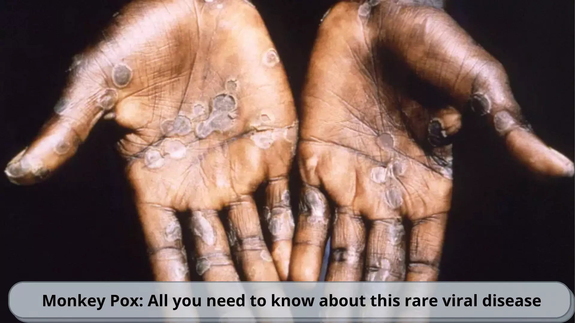 Monkey Pox: All you need to know about this rare viral disease