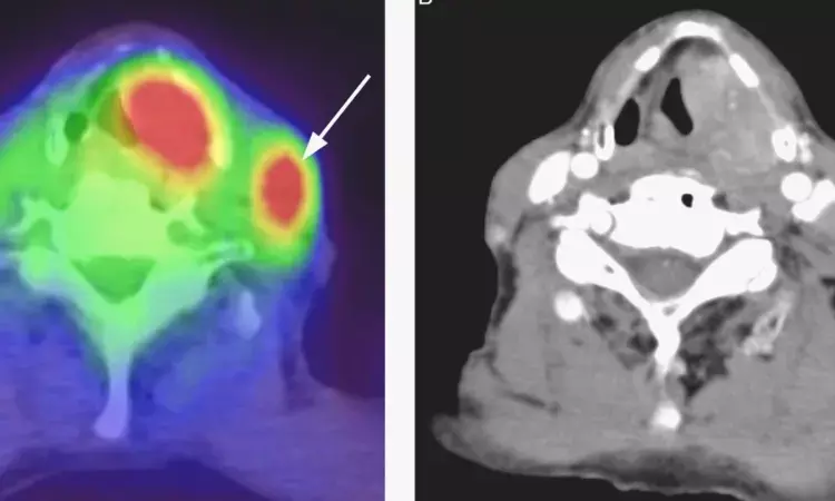 FDG-PET/CT can predict distant metastasis and survival in hypopharyngeal squamous cell carcinoma: Study