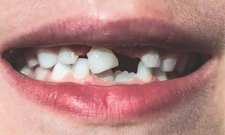 Severe mental illness patients  more likely to lose all their teeth because of poor dental care