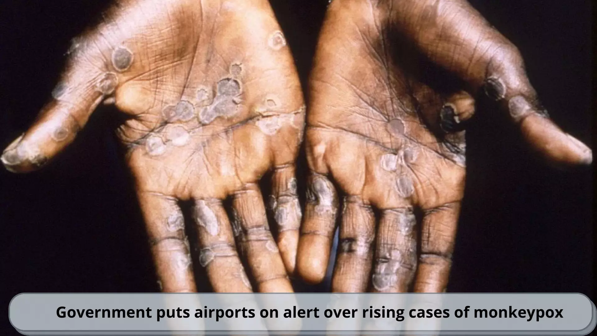 Govt puts airports on alert over rising monkeypox cases