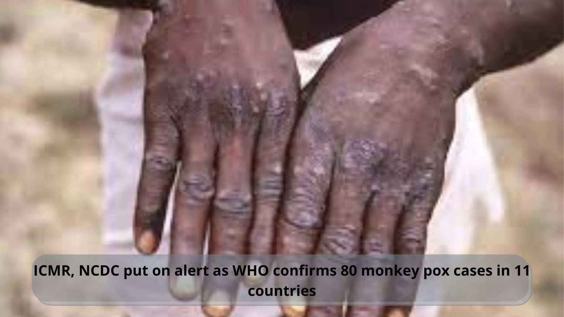 ICMR, NCDC put on alert as WHO confirms 80 monkey pox cases in 11 countries