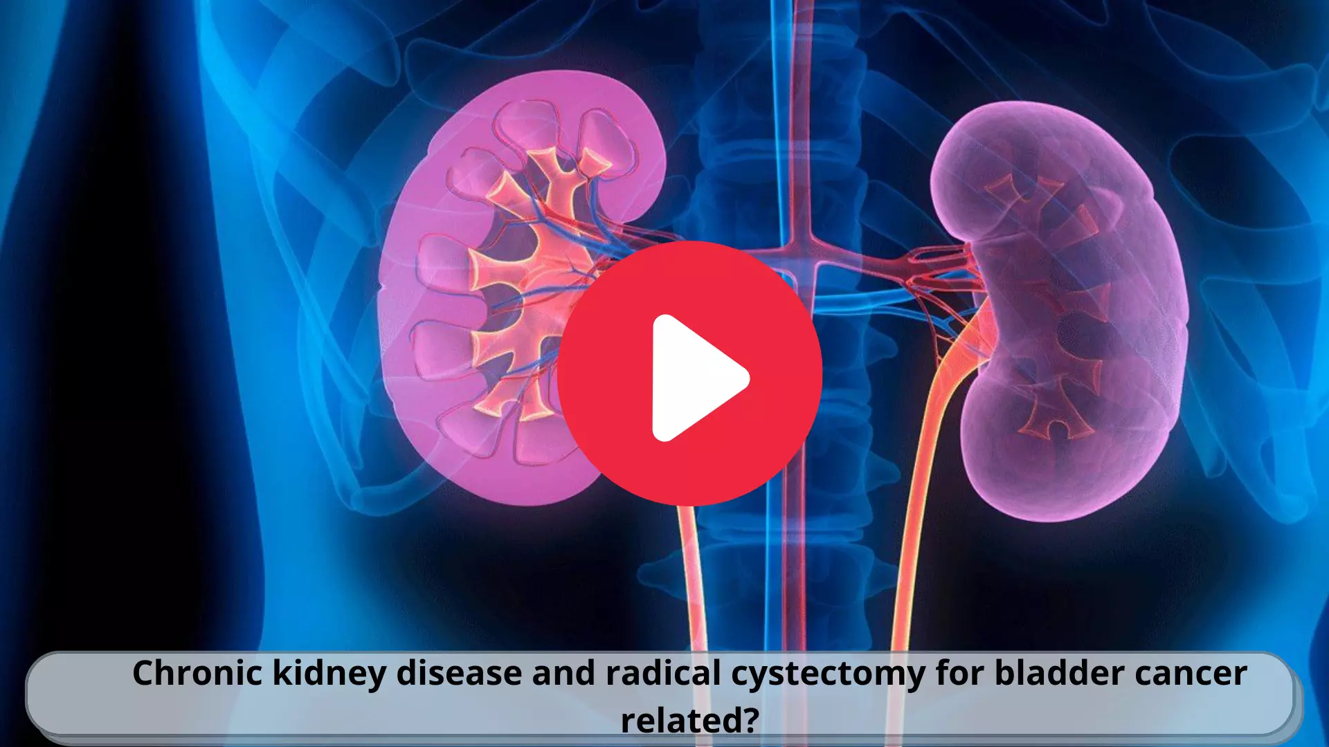 Chronic kidney disease and radical cystectomy for bladder cancer related?