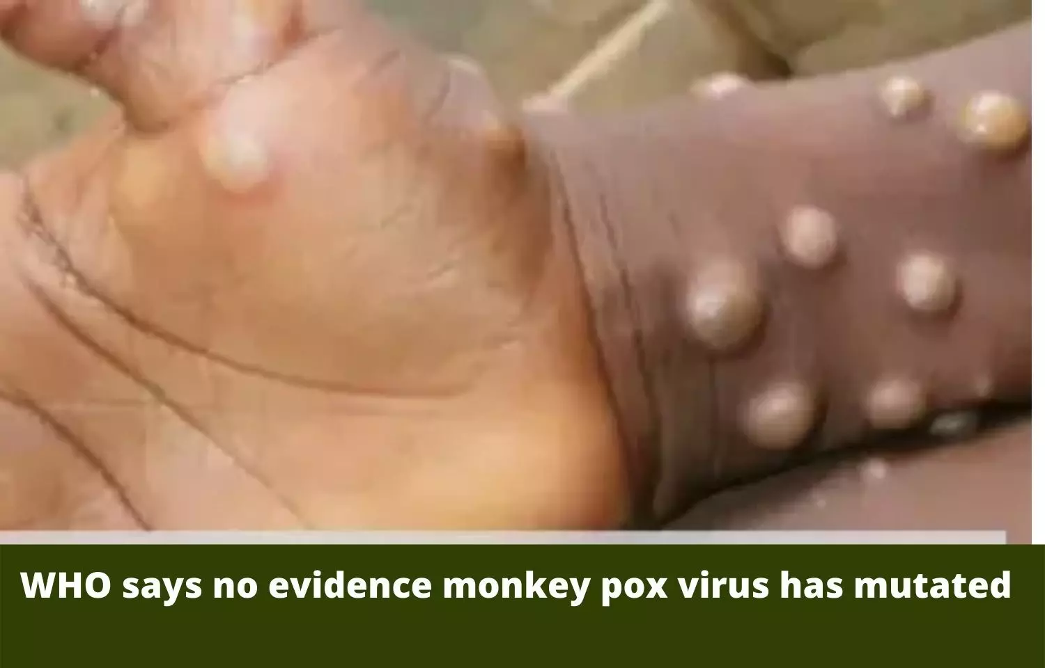 WHO says no evidence monkey pox virus has mutated