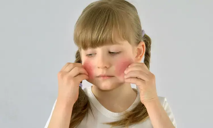 Best Emollient for kids with eczema is the one that they like to use: Study