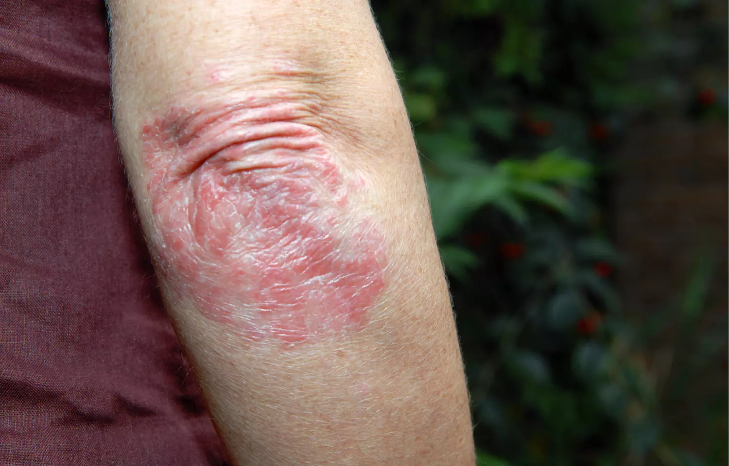 FDA Approves tapinarof cream- first nonsteroidal treatment for plaque psoriasis