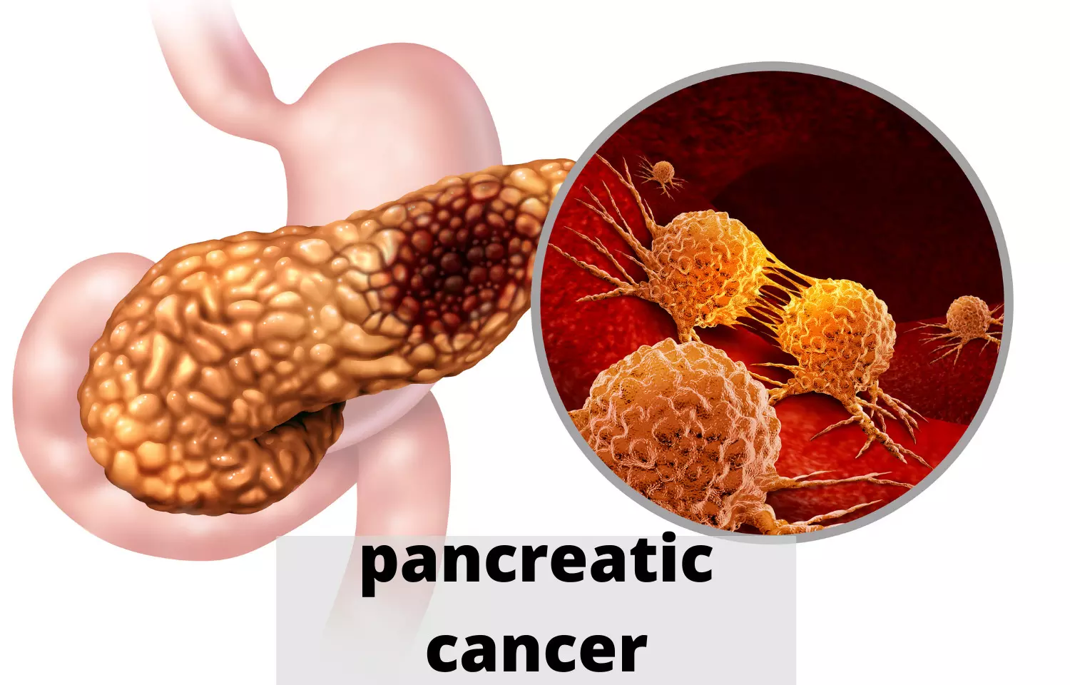Gallstone disease a strong predictor of pancreatic cancer