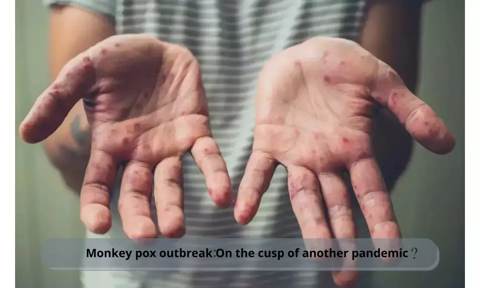 Monkey pox outbreak: On the cusp of another pandemic?
