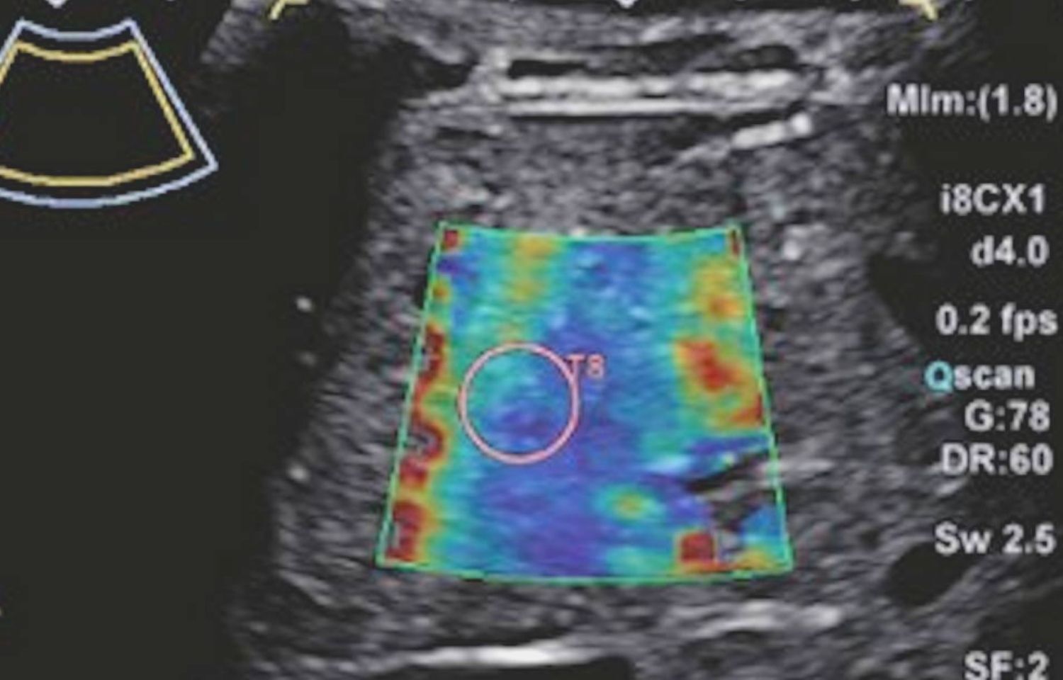 liver fibrosis ultrasound