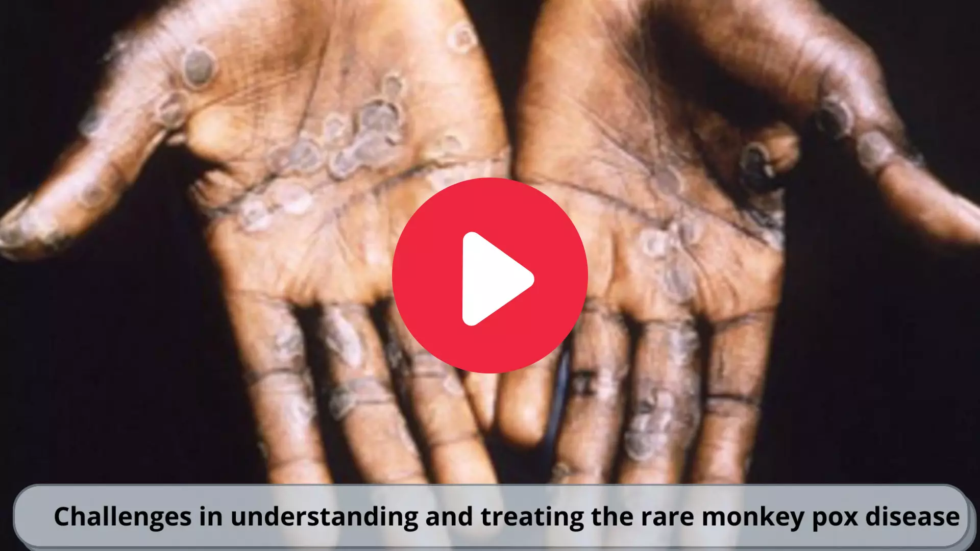 Challenges in understanding and treating the rare monkey pox disease