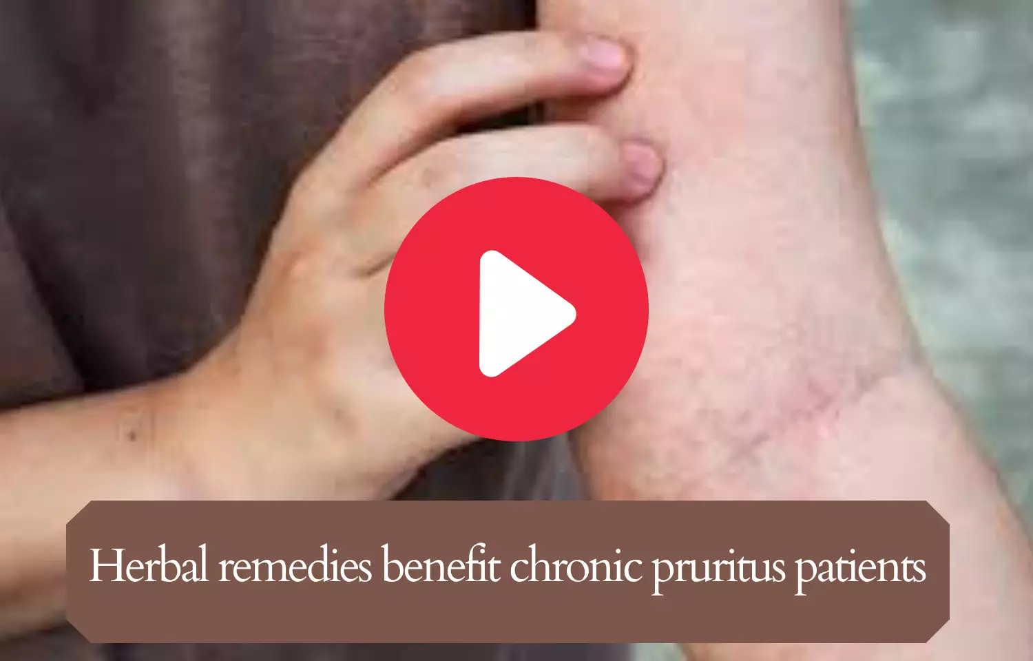 Herbal remedies benefit chronic pruritus patients