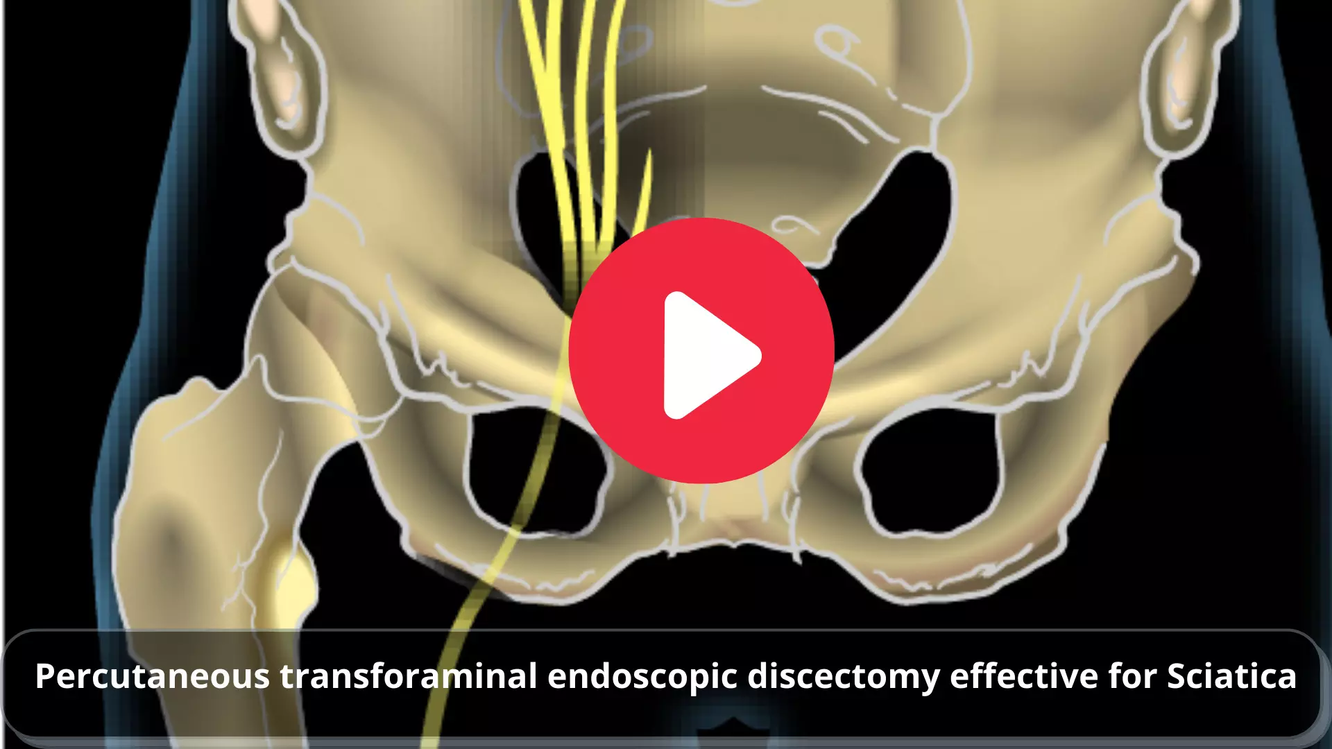 Percutaneous transforaminal endoscopic discectomy effective for Sciatica