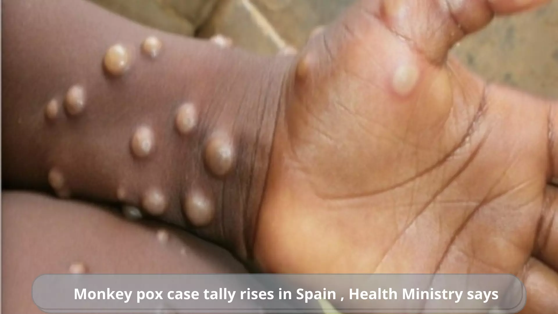 Monkey pox case tally rises in Spain: Health Ministry