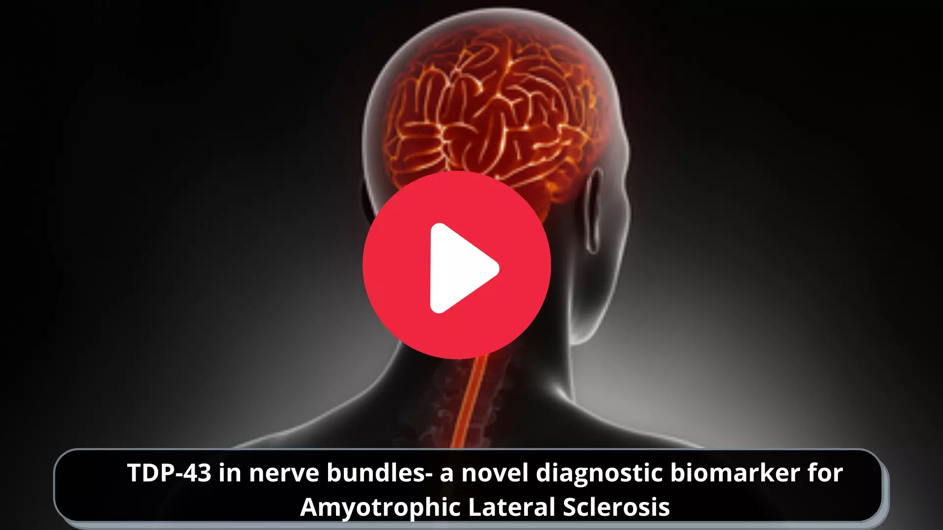 TDP-43 in nerve bundles- a novel diagnostic biomarker for Amyotrophic Lateral Sclerosis