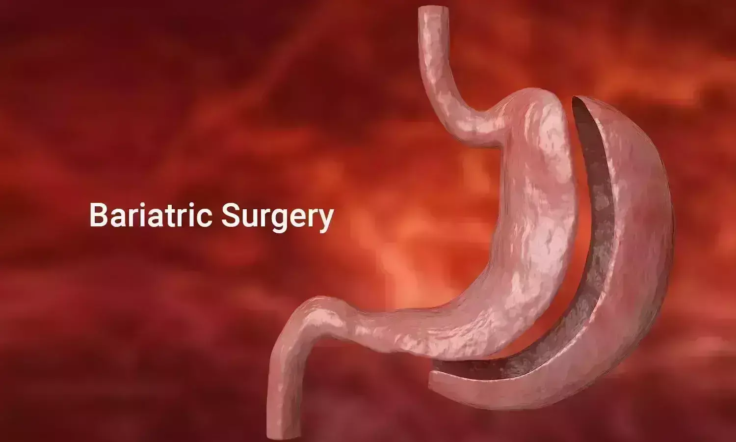 Bariatric surgery associated with disease remission in women with PCOS and obesity