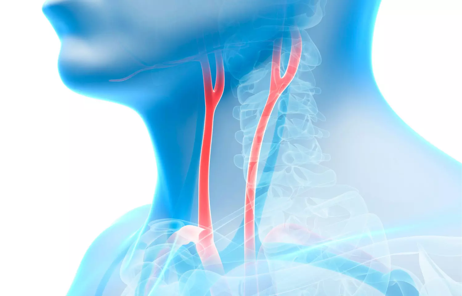 Asymptomatic carotid stenosis has low stroke risk, may not require surgery: JAMA