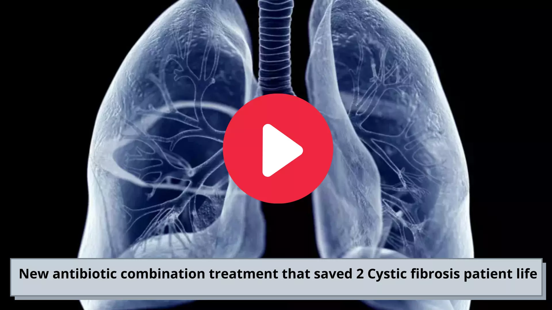 New antibiotic combination treatment to save 2 Cystic fibrosis patient life