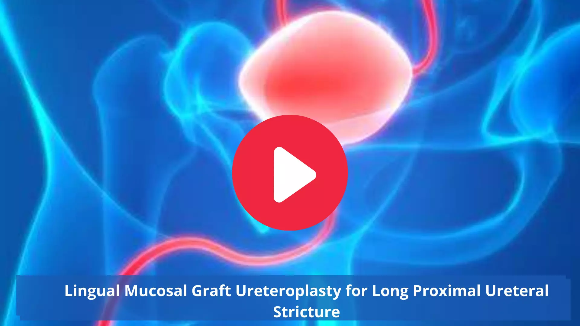 Lingual Mucosal Graft Ureteroplasty for Long Proximal Ureteral Stricture