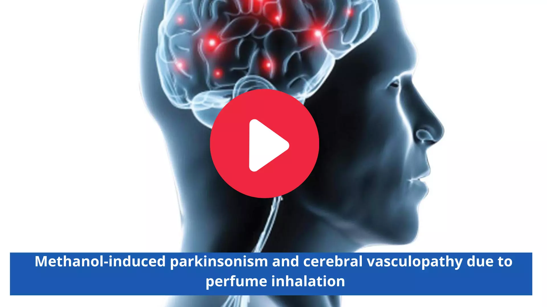 Methanol-induced parkinsonism and cerebral vasculopathy due to perfume inhalation