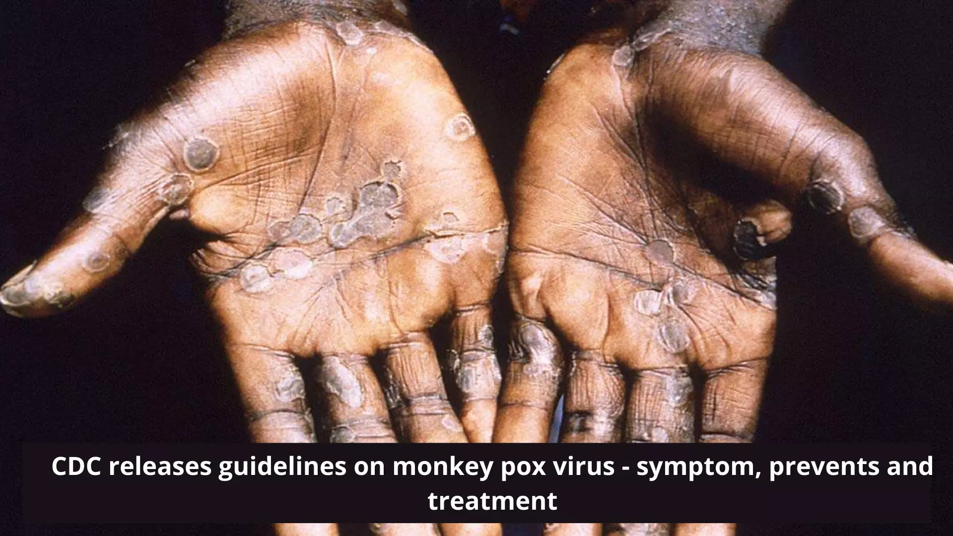 CDC releases guidelines on Monkey Pox virus