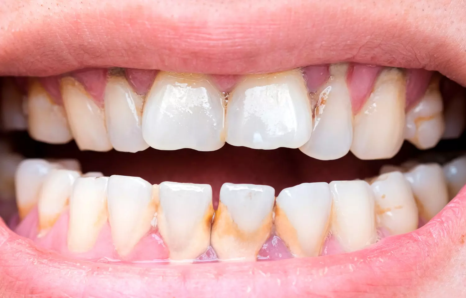 Diabetes may weaken teeth and promote tooth decay