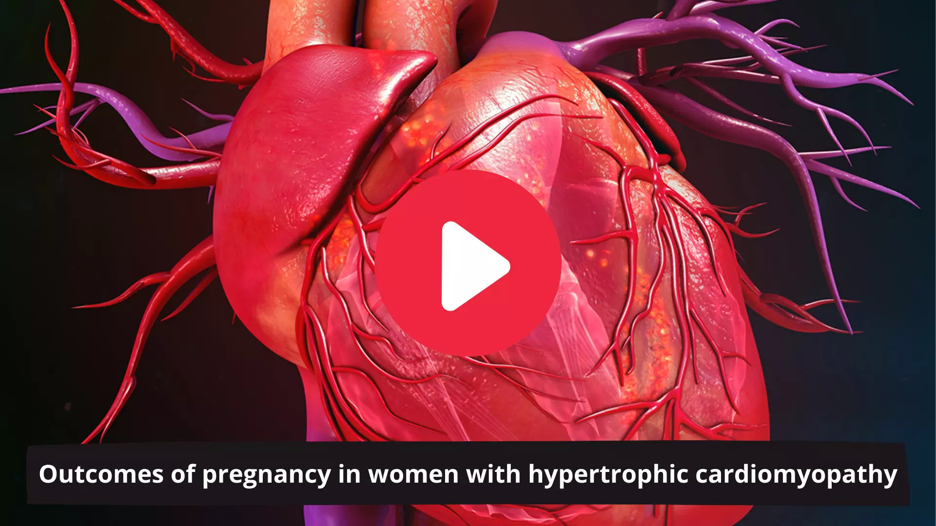 Outcomes of pregnancy in women with hypertrophic cardiomyopathy