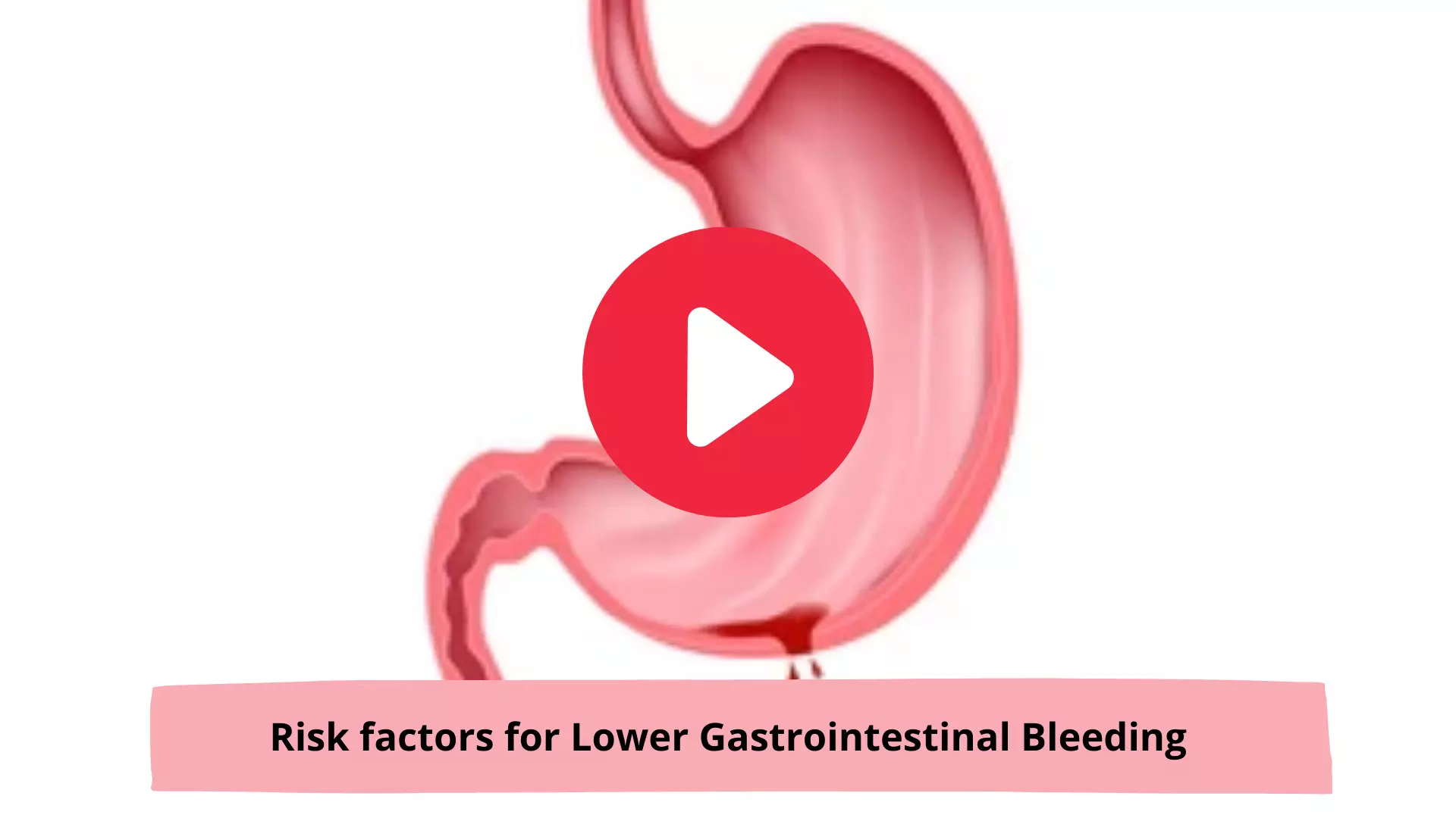 Risk factors for Lower Gastrointestinal Bleeding