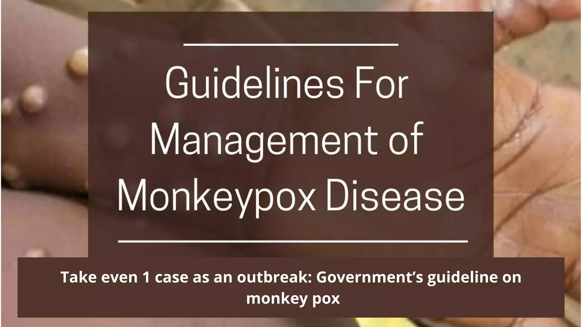 Ministry of Health issues guidelines on management of Monkeypox