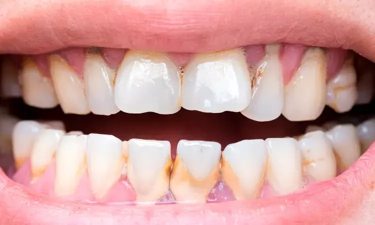 Diabetes may weaken teeth and promote tooth decay