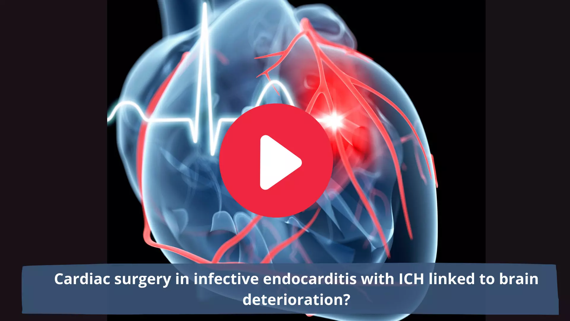 Cardiac surgery in infective endocarditis with ICH linked to brain deterioration?
