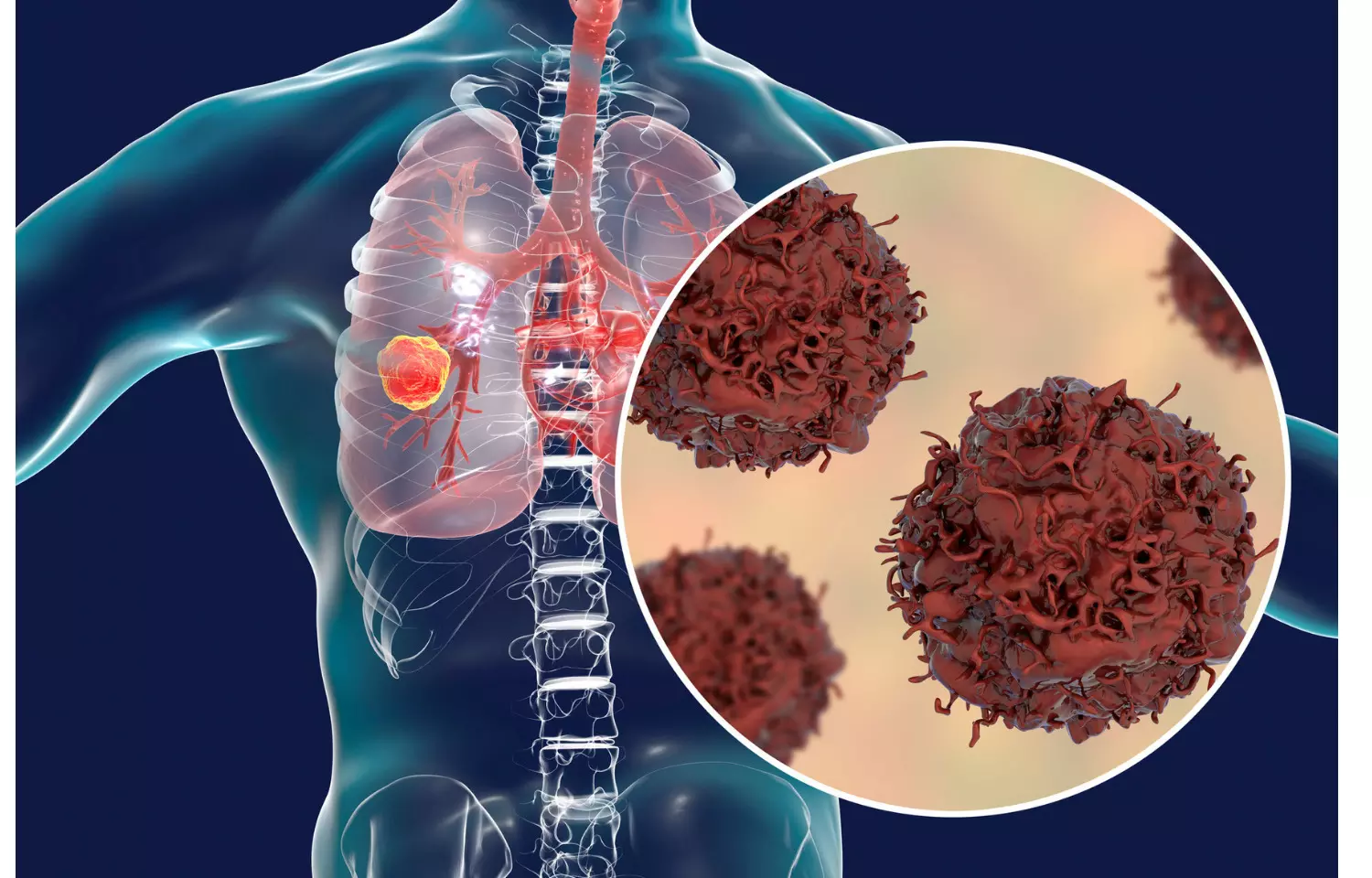 New drug combination improves survival for some with lung cancer