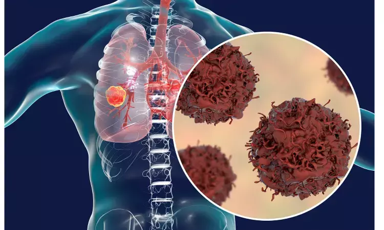 New drug combination improves survival for some with lung cancer