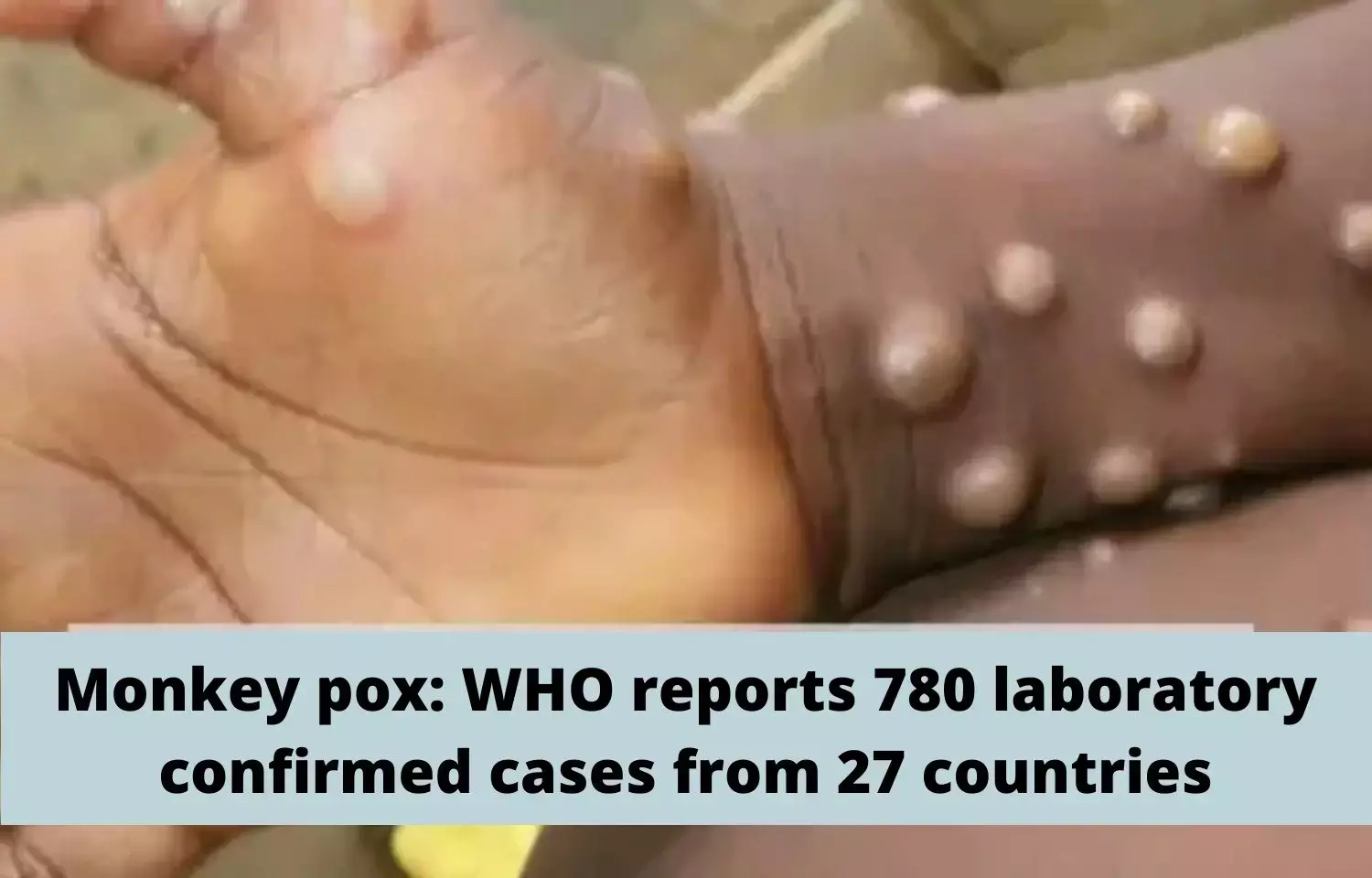 Monkey pox: WHO reports 780 laboratory confirmed cases from 27 countries Monkey pox: WHO reports 780 laboratory confirmed cases from 27 countries