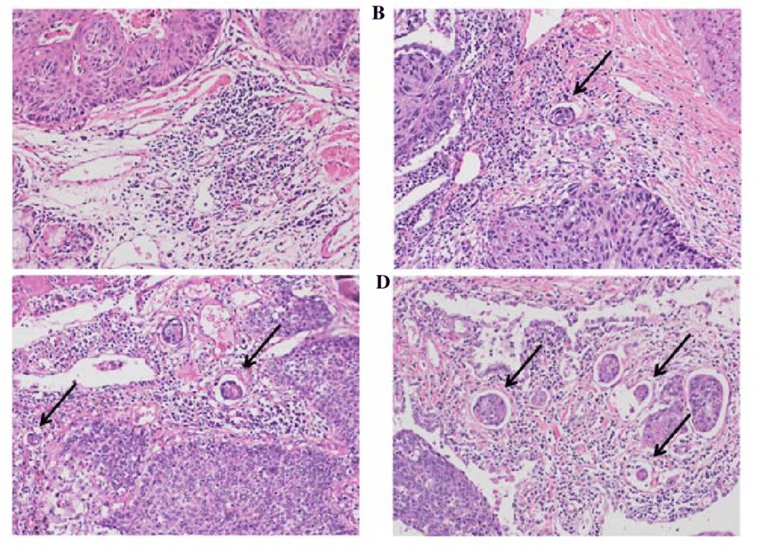 squamous-cell-lung-cancer-patients-with-diabetes-at-higher-risk-of-all