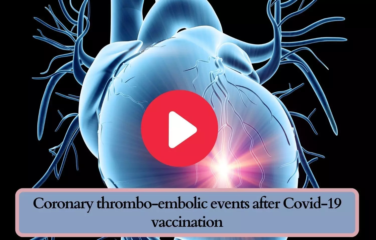 Coronary thrombo-embolic events after Covid-19 vaccination