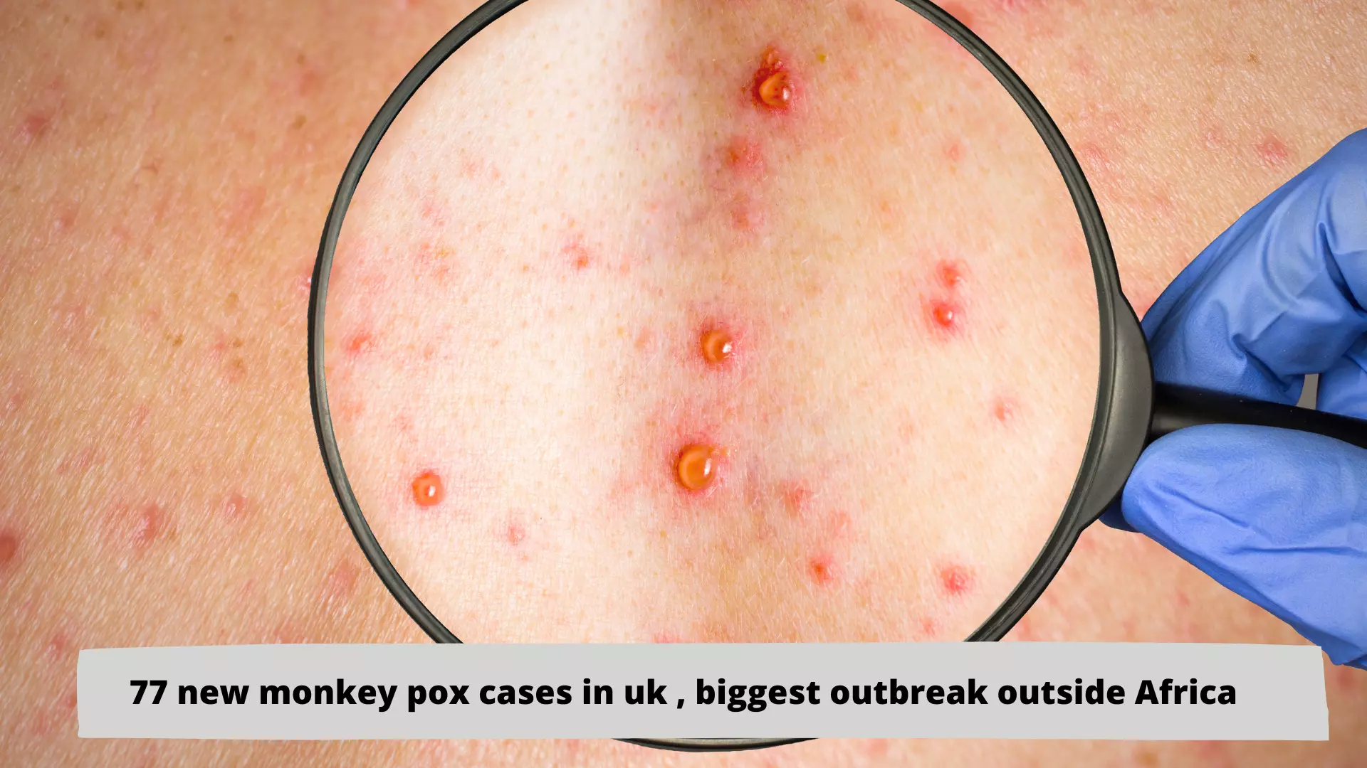 77 new monkey pox cases in UK, biggest outbreak outside Africa