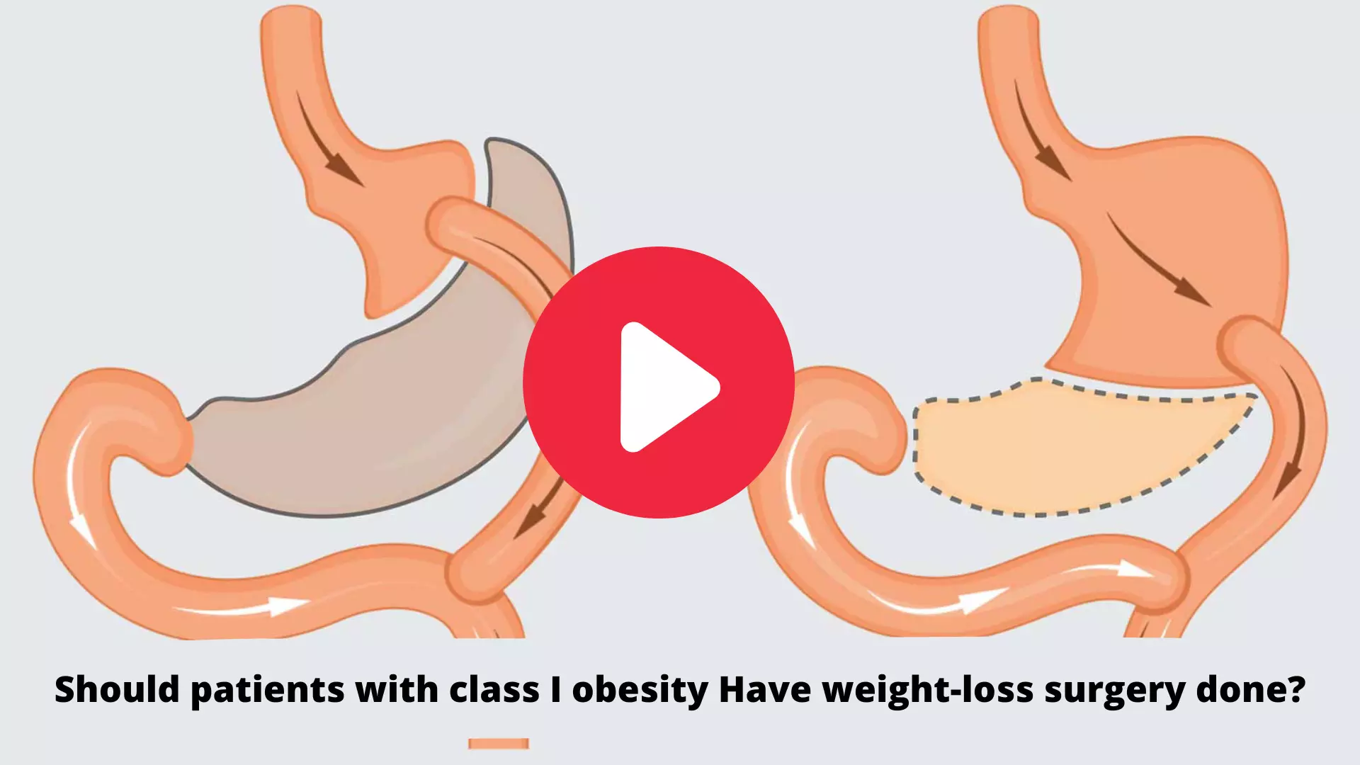 Should patients with class I obesity Have weight-loss surgery done?