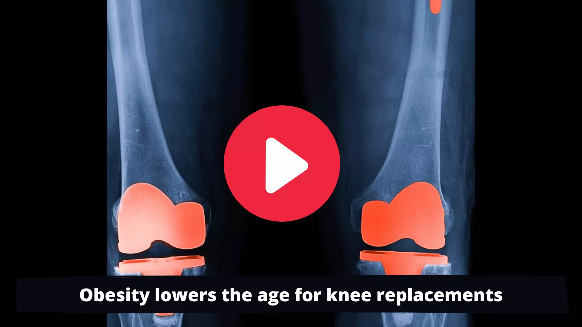 Obesity lowers the age for knee replacements
