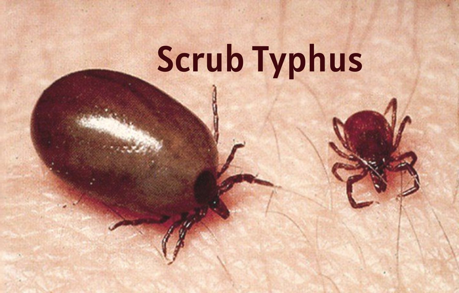 Murine Typhus Definition In Tamil