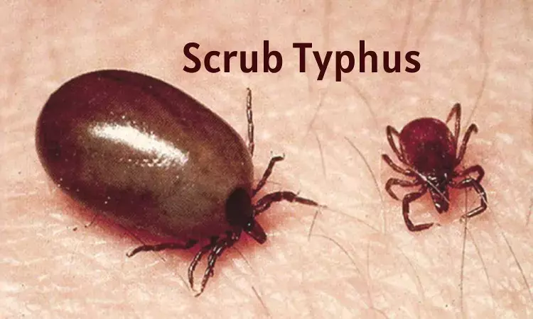 Kerala Girl Succumbs to Scrub Typhus