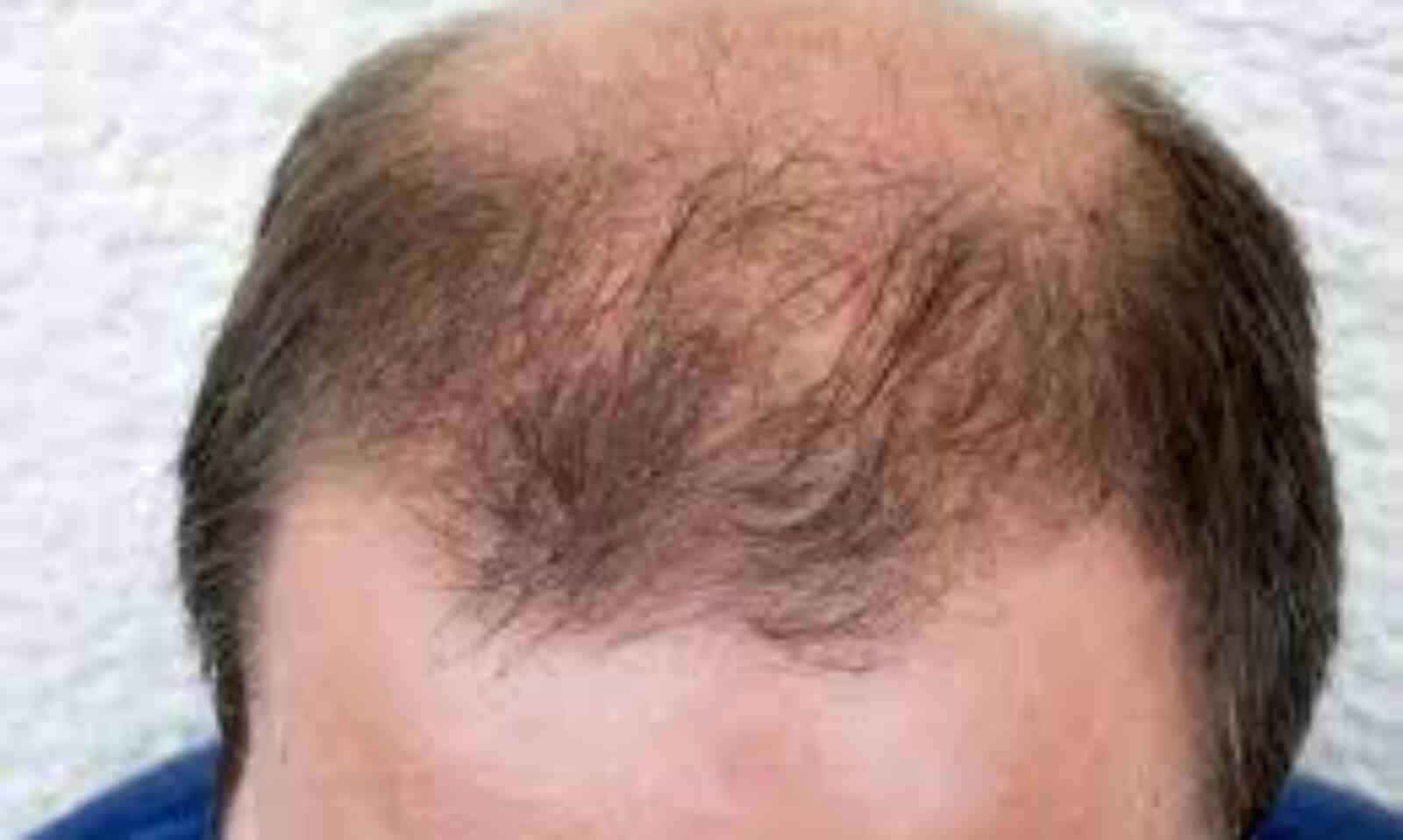Types of Hair Loss  Ways to Remedy  Sisterlocked